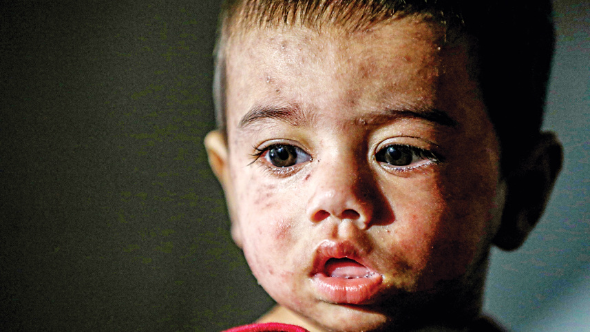 Measles outbreak: Stop the blame game, start saving lives