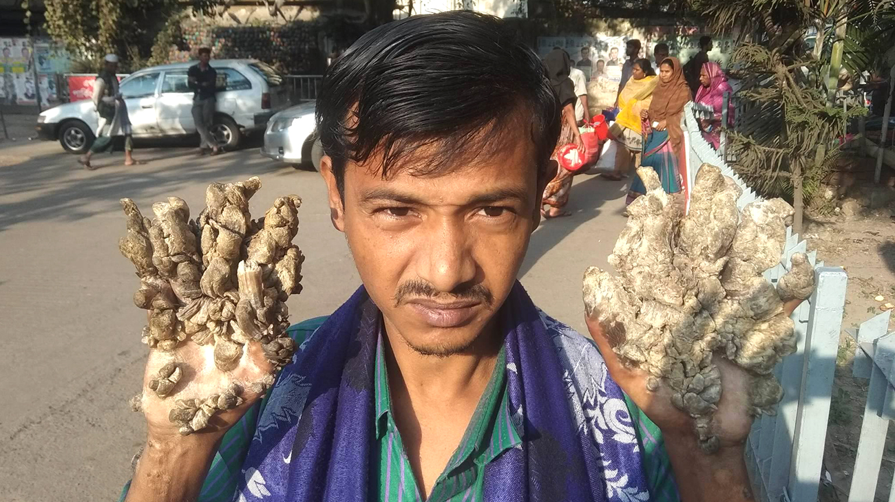 'Tree-man' wants treatment abroad