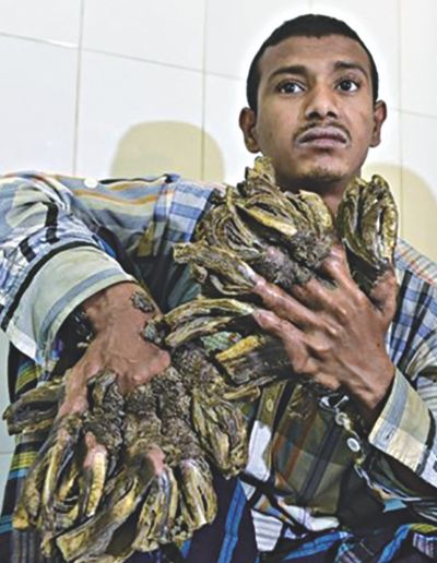 'Tree-man' gives up hope