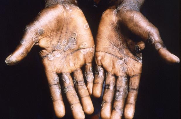 Expect to detect more monkeypox cases, WHO says