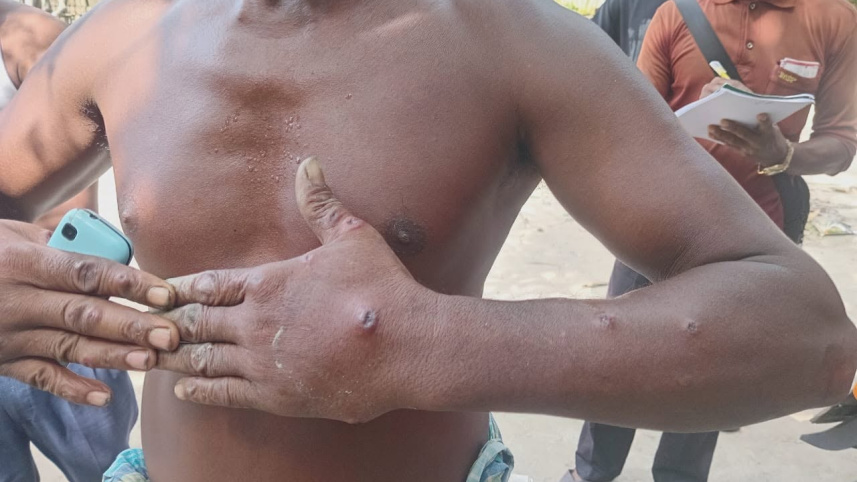 anthrax outbreak in Gaibandha 2026
