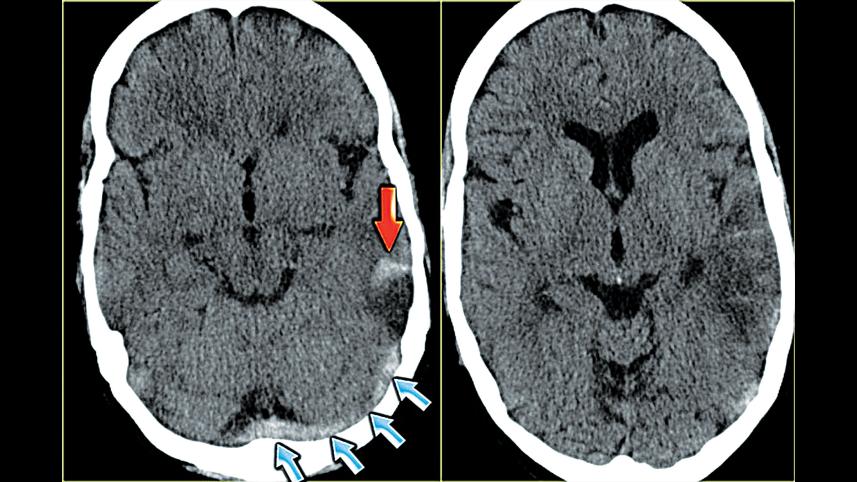 cerebral-venous-thrombosis-after-COVID-19.jpg