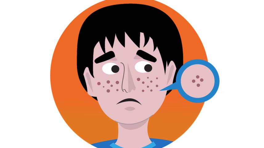 acne.jpg