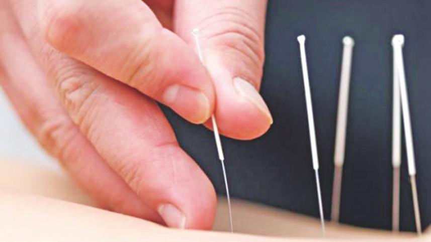 Acupuncture.jpg
