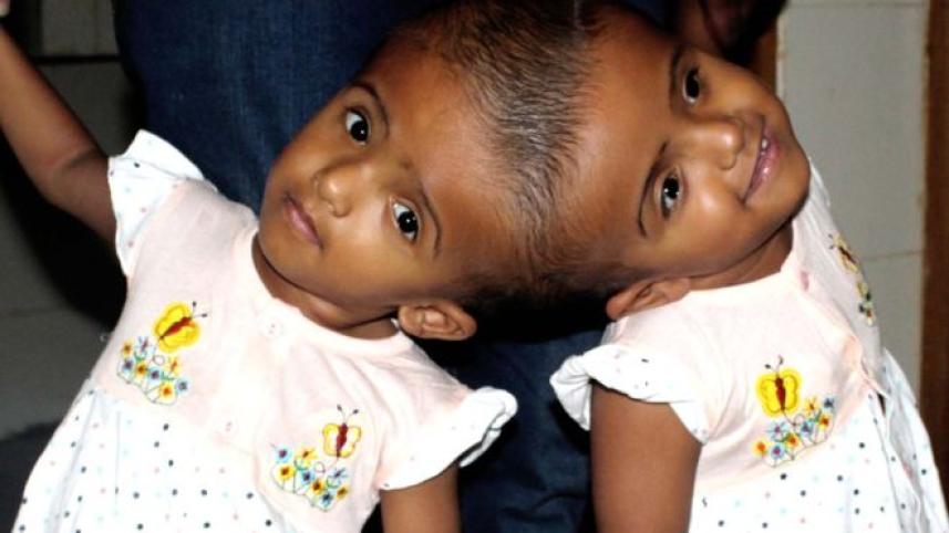 conjoined twins Rabeya and Rokaia