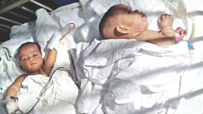 Conjoined separated.jpg