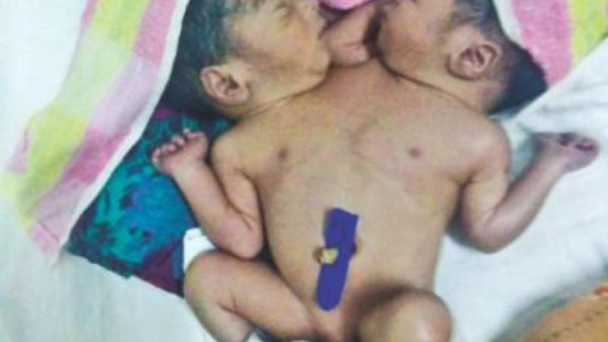 Conjoined twins.jpg