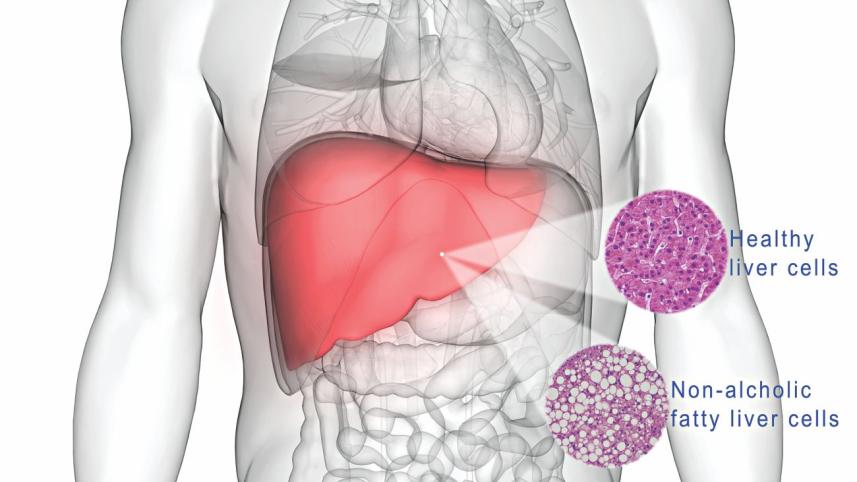 Fatty liver disease.jpg