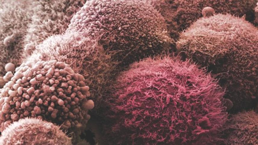 Pancreatic cancer.jpg