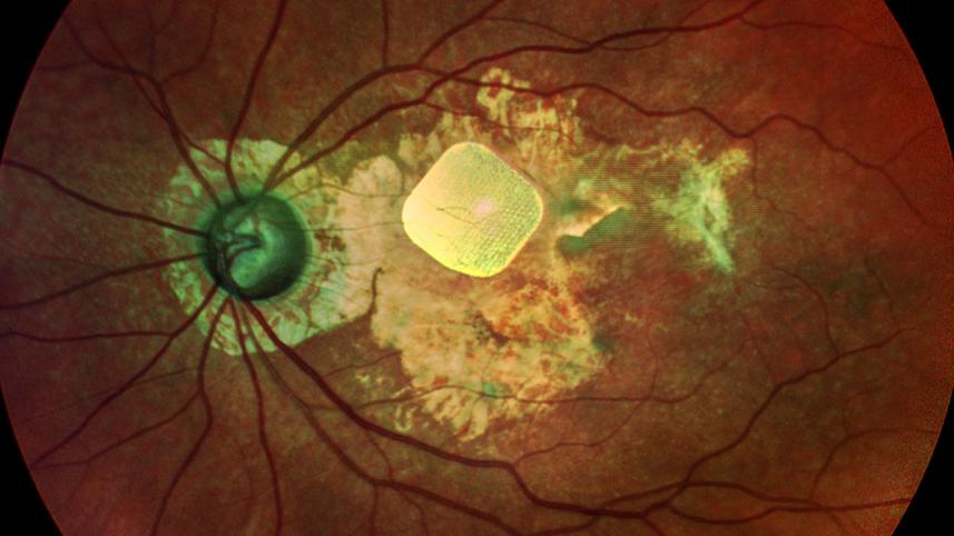 prima-in-eye-fundus_online.jpg