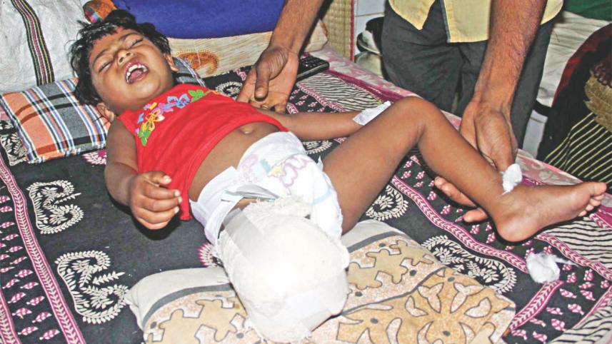 toddler lost leg.jpg