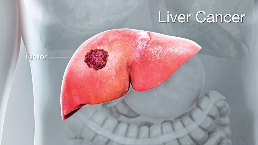 liver-cancer.jpg