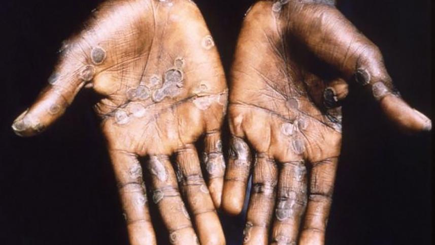 monkeypox virus