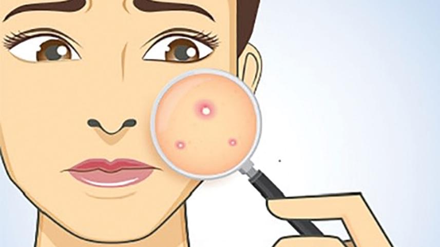 acne-occurs.jpg