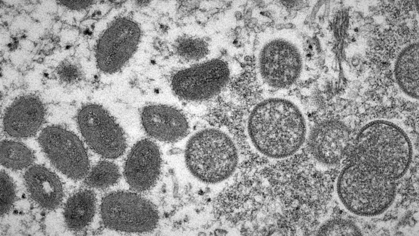 monkeypox death in India