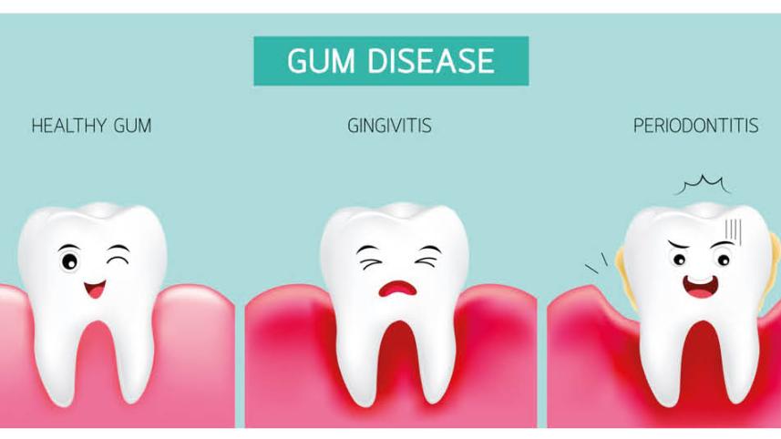 Parodontax Bleeding gums