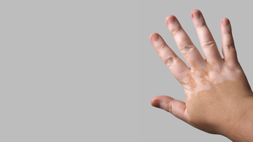 vitiligo_thumbnail.png