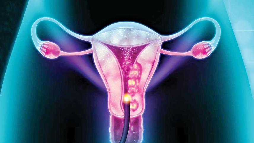 cervical-cancer.jpg