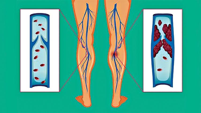 deep-vein-thrombosis.jpg