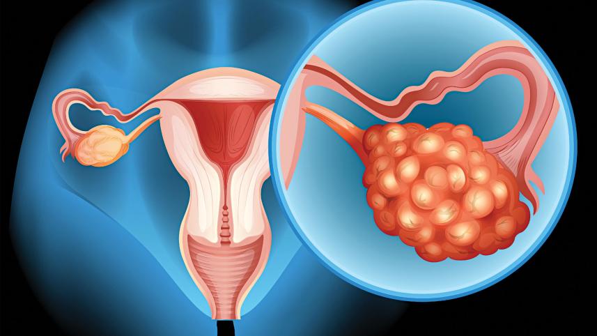 ovarian-cancer.jpg