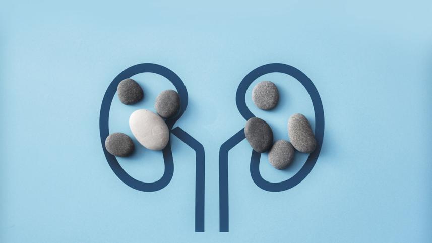 kidney-stones.jpg
