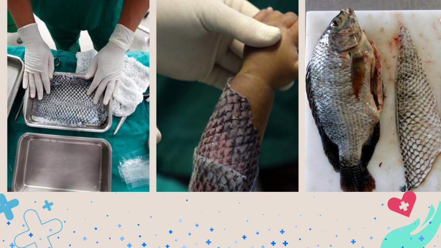 Healing burns! The remarkable benefits of tilapia skin