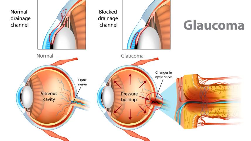 what-is-glaucoma.jpg