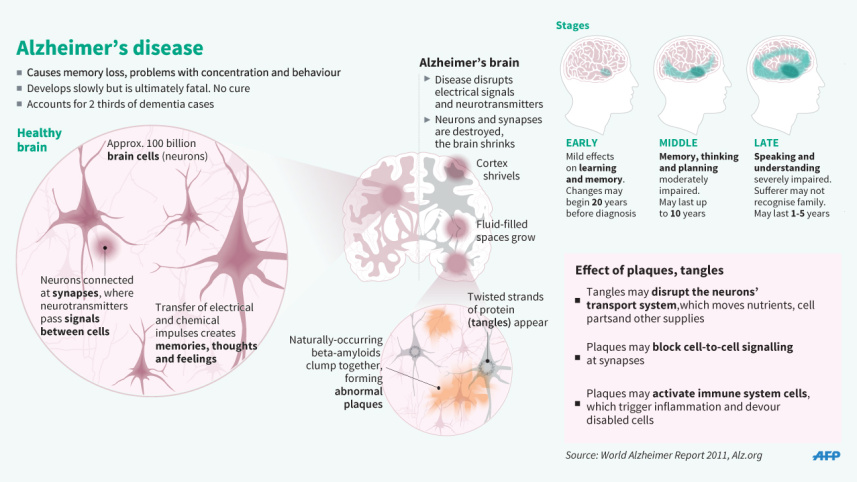 alzheimers-3_afp.jpg