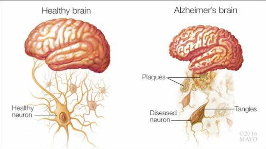 alzheimers_brain_mayo_clinic_0.jpg