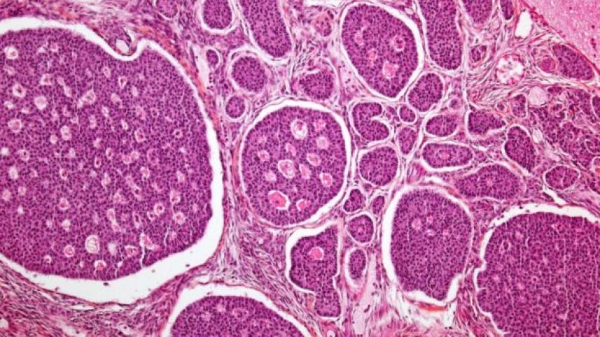 ovarian cancer 2.jpg