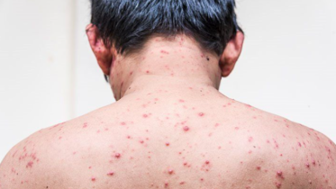 chickenpox-web.png