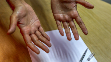 students with hyperhidrosis.jpg