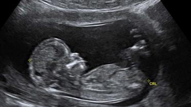 ULTRASOND CRL_Crown_rump_lengh_12_weeks_ecografia_Dr-1._Wolfgang_Moroder-1024x633.jpg