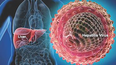 viral hepatitis