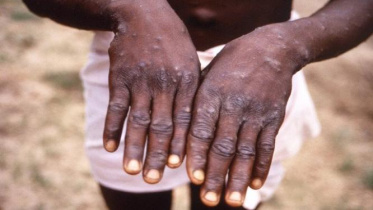 monkey-pox-reuters-1.jpeg