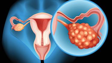 ovarian-cancer.jpg