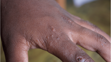 typical-scabies-lesions-on-a-childs-fingers.png