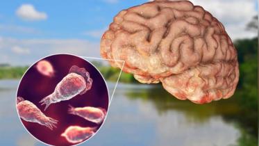 brain-eating amoeba cases in India