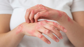 Leprosy-Day-2026.jpg