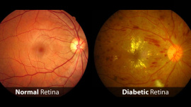 Diabetic retinopathy