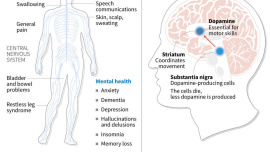 Parkinson's disease.jpg