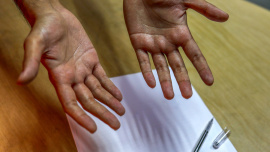students with hyperhidrosis.jpg