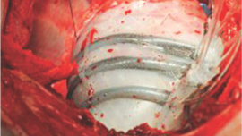 Robot Helps the Heart Beat