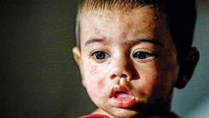 measles cases rising in Bangladesh