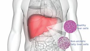 Fatty liver disease.jpg