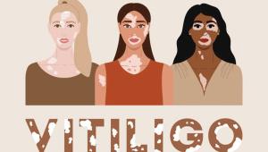 vitiligo.jpg