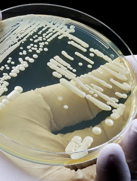 Drug resistant fungus in Dhaka hospitals